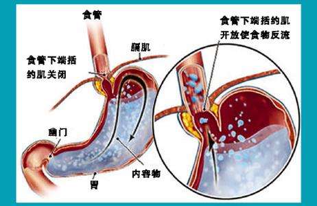 中医方法如何治反流性食管炎 不用吃什么药