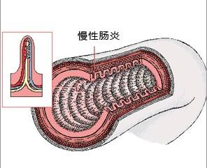 关于慢性结肠炎症状的治疗 中医有说法