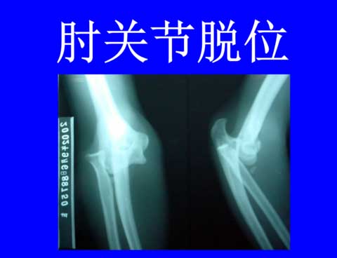 肘关节脱位是什么症状和表现用中医来解释