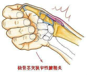 桡骨茎突狭窄性腱鞘炎是什么症状和表现用中医来解释