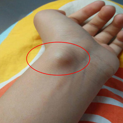 腱鞘囊肿是什么症状和表现用中医来解释