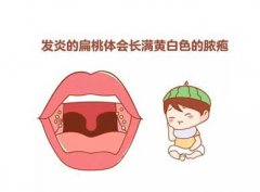 扁桃体发炎是什么症状和表现用中医来解释