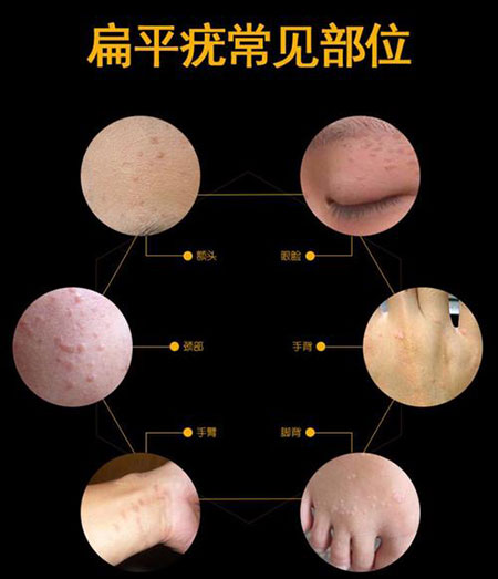 扁平疣是什么症状和表现用中医来解释
