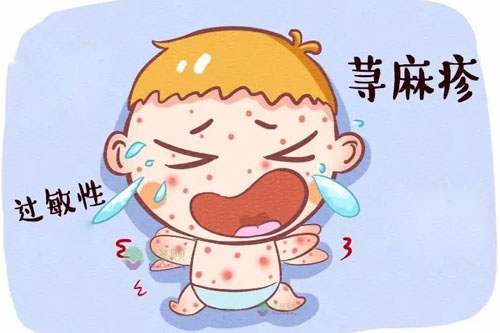 荨麻疹是什么症状和表现用中医来解释