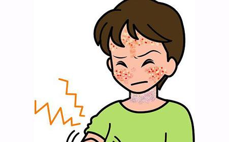 神经性皮炎是什么症状和表现用中医来解释