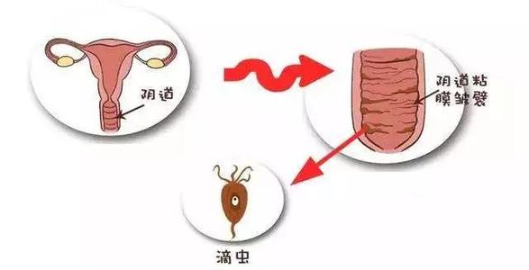 阴道滴虫病是什么症状和表现用中医来解释