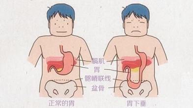 胃下垂的症状