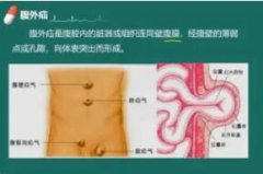 疝(腹股沟斜疝、直疝)是怎样发生的?